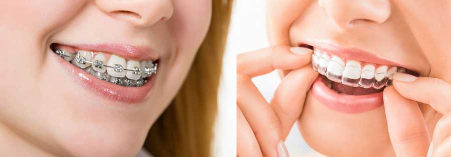 Braces Aligners Smile More Dental Clinics